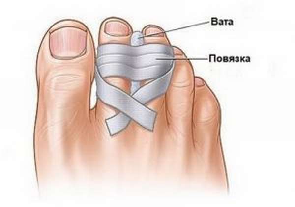 Наложение повязки при ушибе пальцев ног
